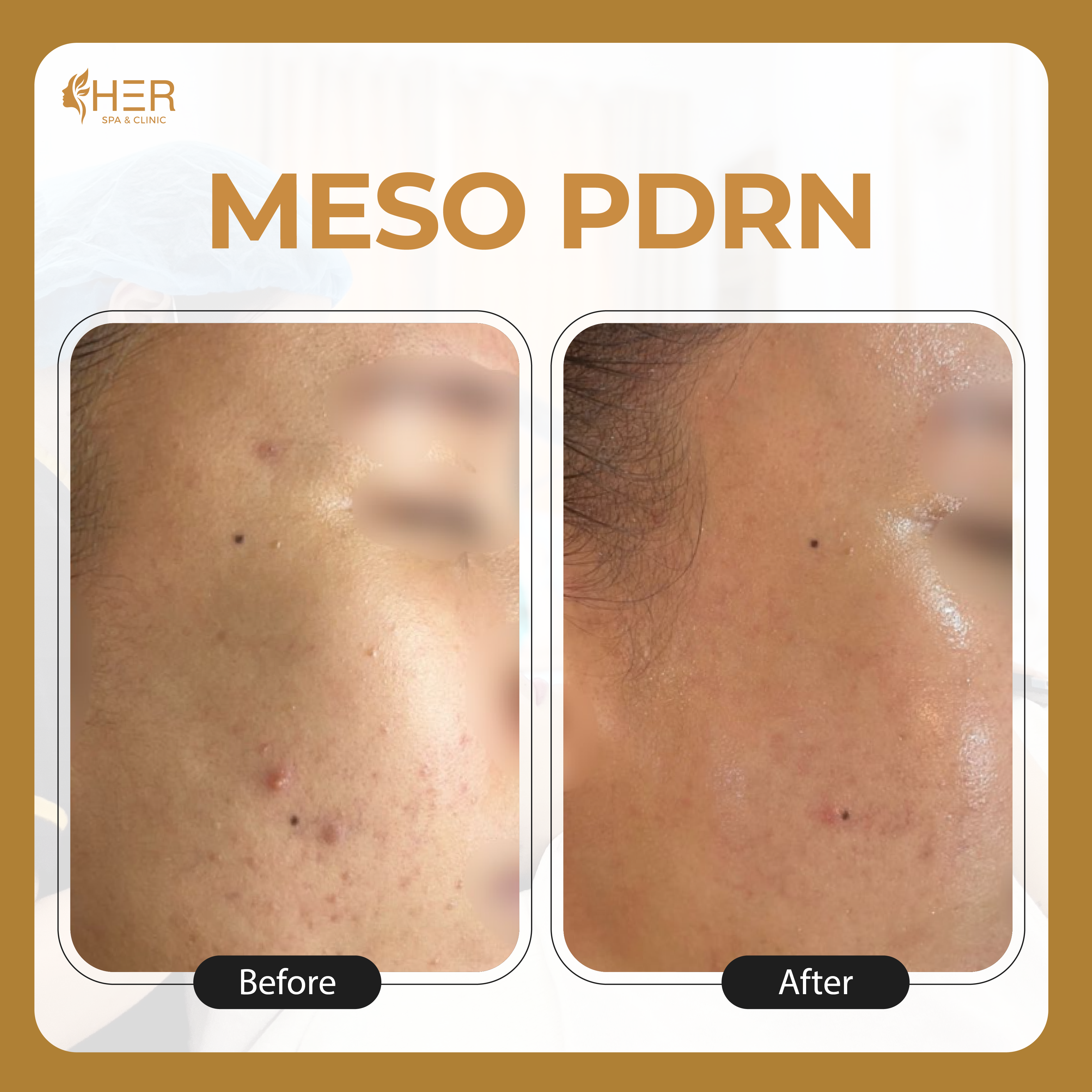 Meso PDRN - Mesotherapy phục hồi cấu trúc đa tầng